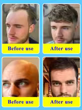 hair growth product, say goodbye to baldness in 7 days. Also effective for beard, ches