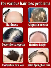 hair growth product, say goodbye to baldness in 7 days. Also effective for beard, ches