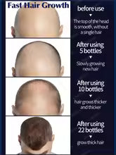 hair growth product, say goodbye to baldness in 7 days. Also effective for beard, ches